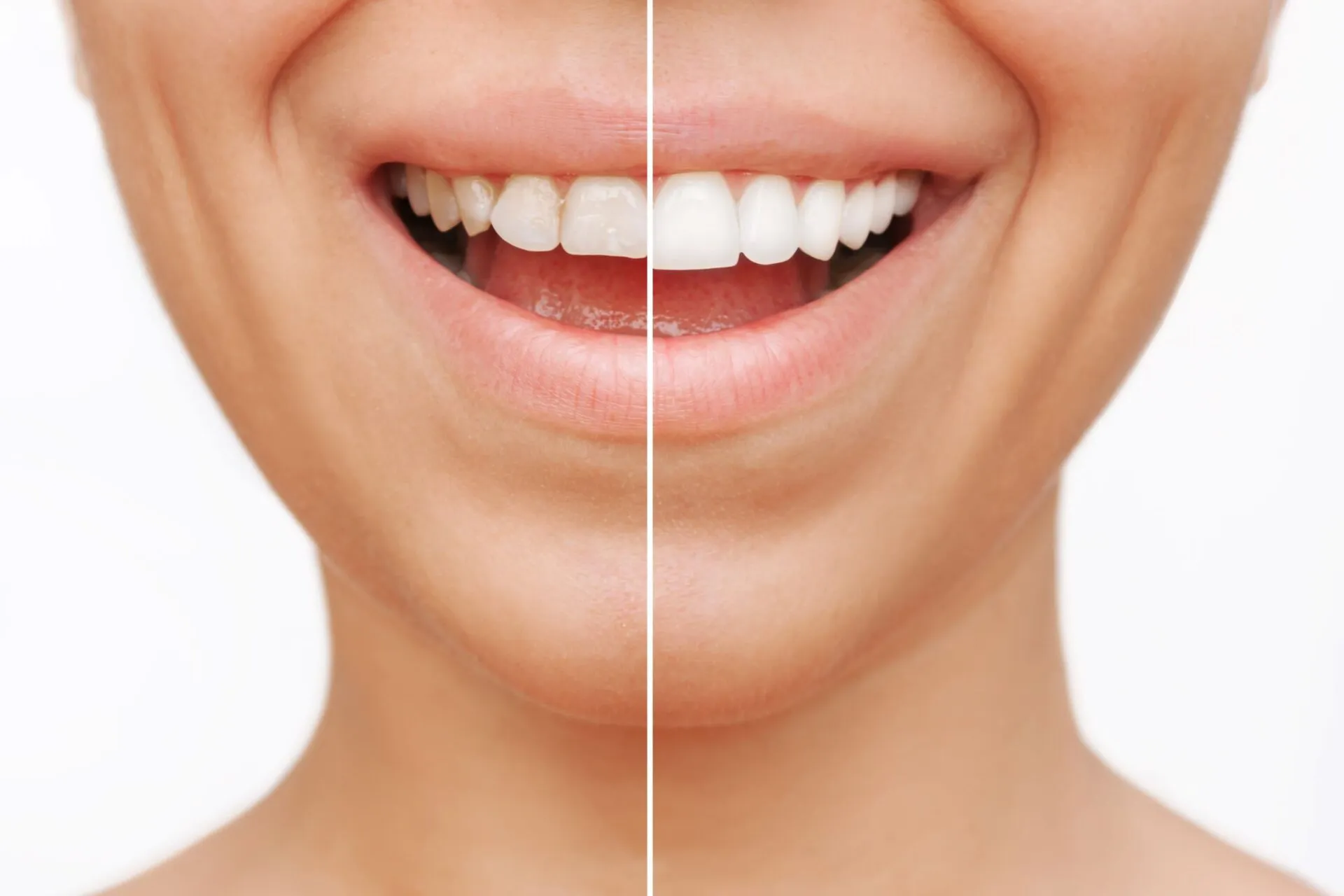 What Are Porcelain Veneers And Are They Right For You?